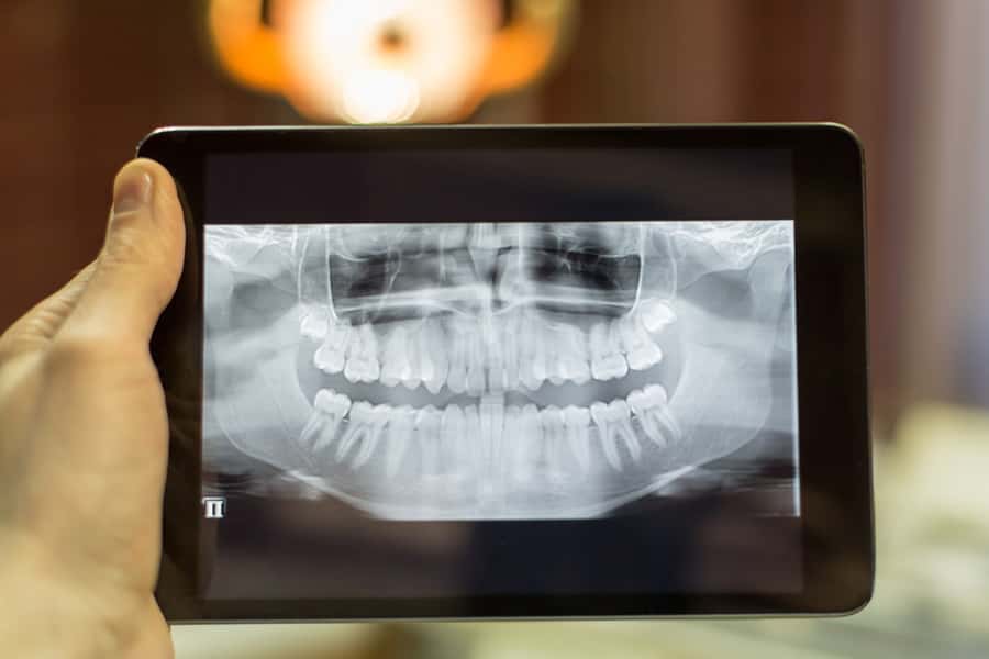 State Street Dental in Chicago near DePaul University uses dental x-rays detect cavities. Dental X-Rays in Chicago near Millennium Park