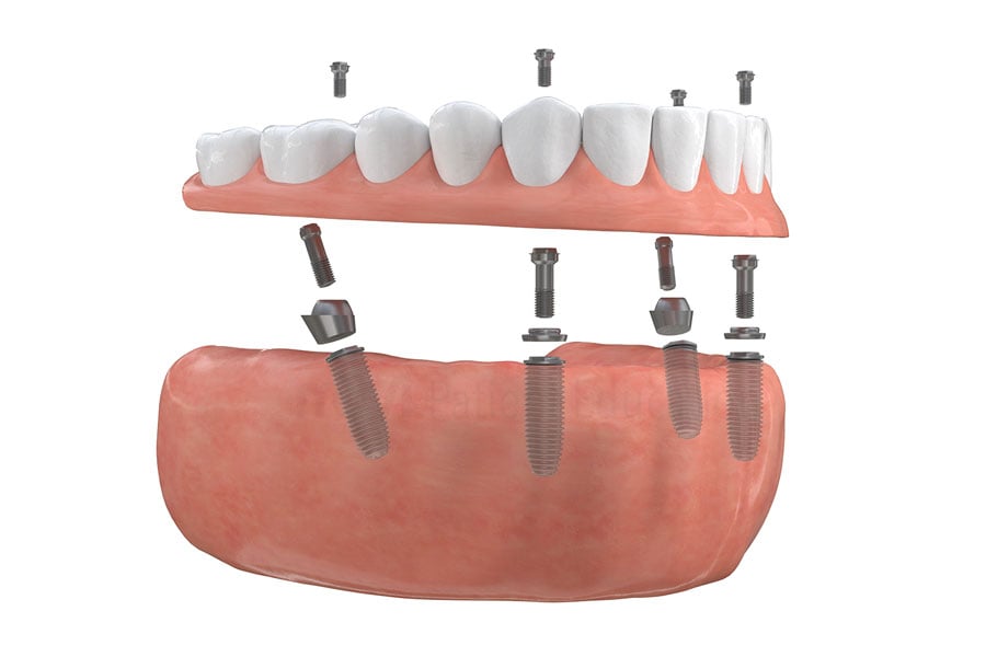 Long-term alternative to dentures from dental expert Dr. Raffi in Bourbonnais, IL. Full Mouth Restoration near Millennium Park in Chicago, IL