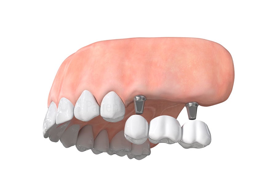 Fix multiple missing teeth with a implant bridge in Chicago near DePaul University. Dental Implant Bridge in Chicago near DePaul University