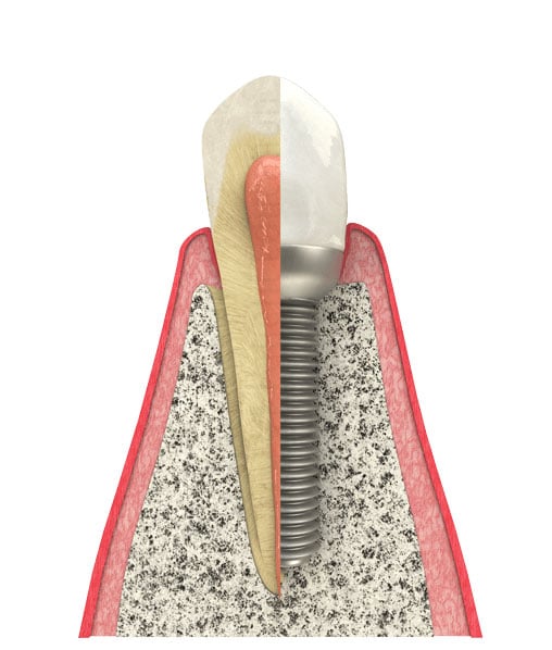 Benefits of dental implants for replacing a missing tooth in Chicago near DePaul University. Benefits of Dental Implants in Chicago near Printer's Row