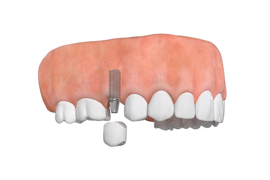 Dental implants versus traditional bridge near Printer's Row, Chicago Dental Implants near Printer's Row, Chicago
